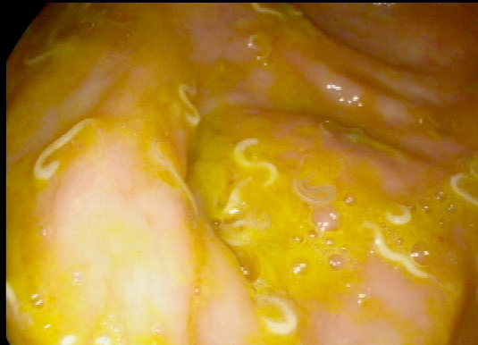 Parasites In Your That S B Fig 7 Healthy Ascending Colon Filled With Wormucus