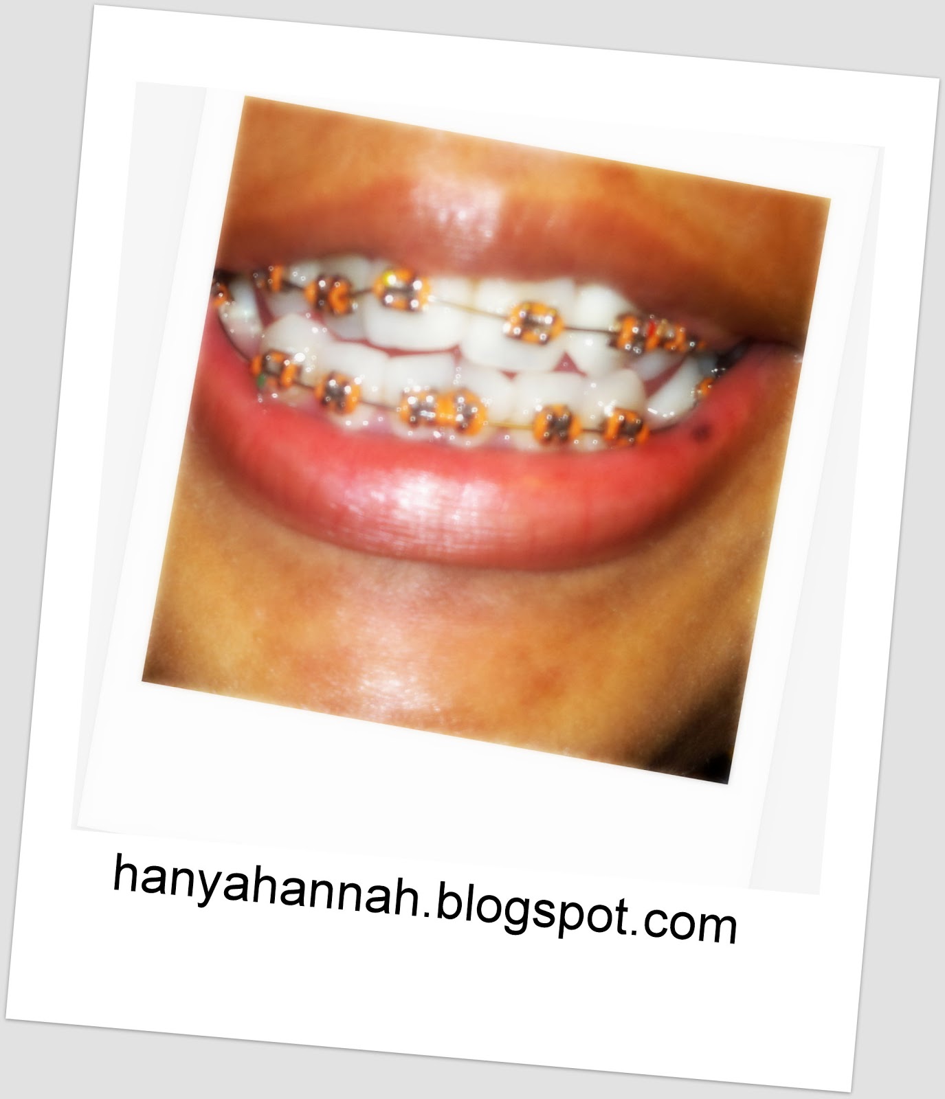 Hannah Haykhall Pengalaman Pakai Braces A K A Pendakap Gigi