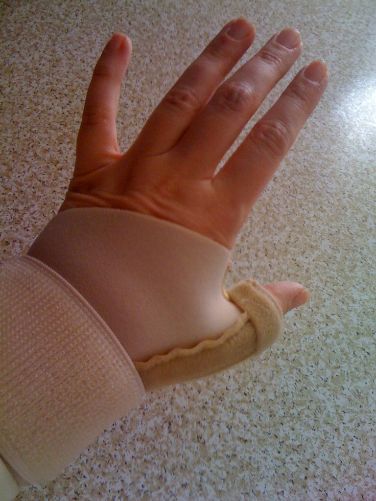 Carpometacarpal Joint Arthritis