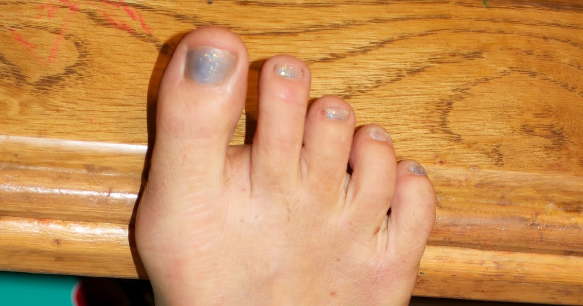 Life in the Slow Lane Effects of Cortisone Shots, One Year Later