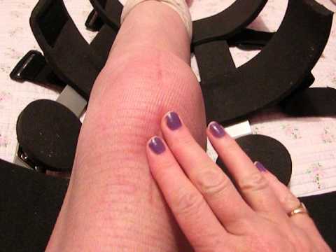 Sports and Community Physiotherapy: The Hypertrophied Patella – Does it