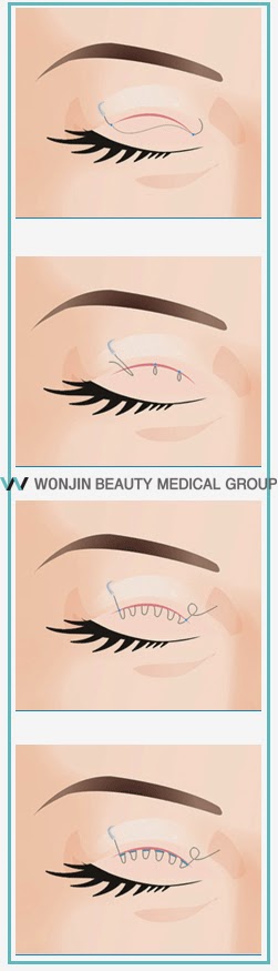 eyelid_surgery_wonjin_cosmetic