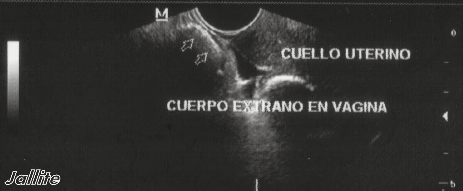 Cuerpo Extraño en Vagina