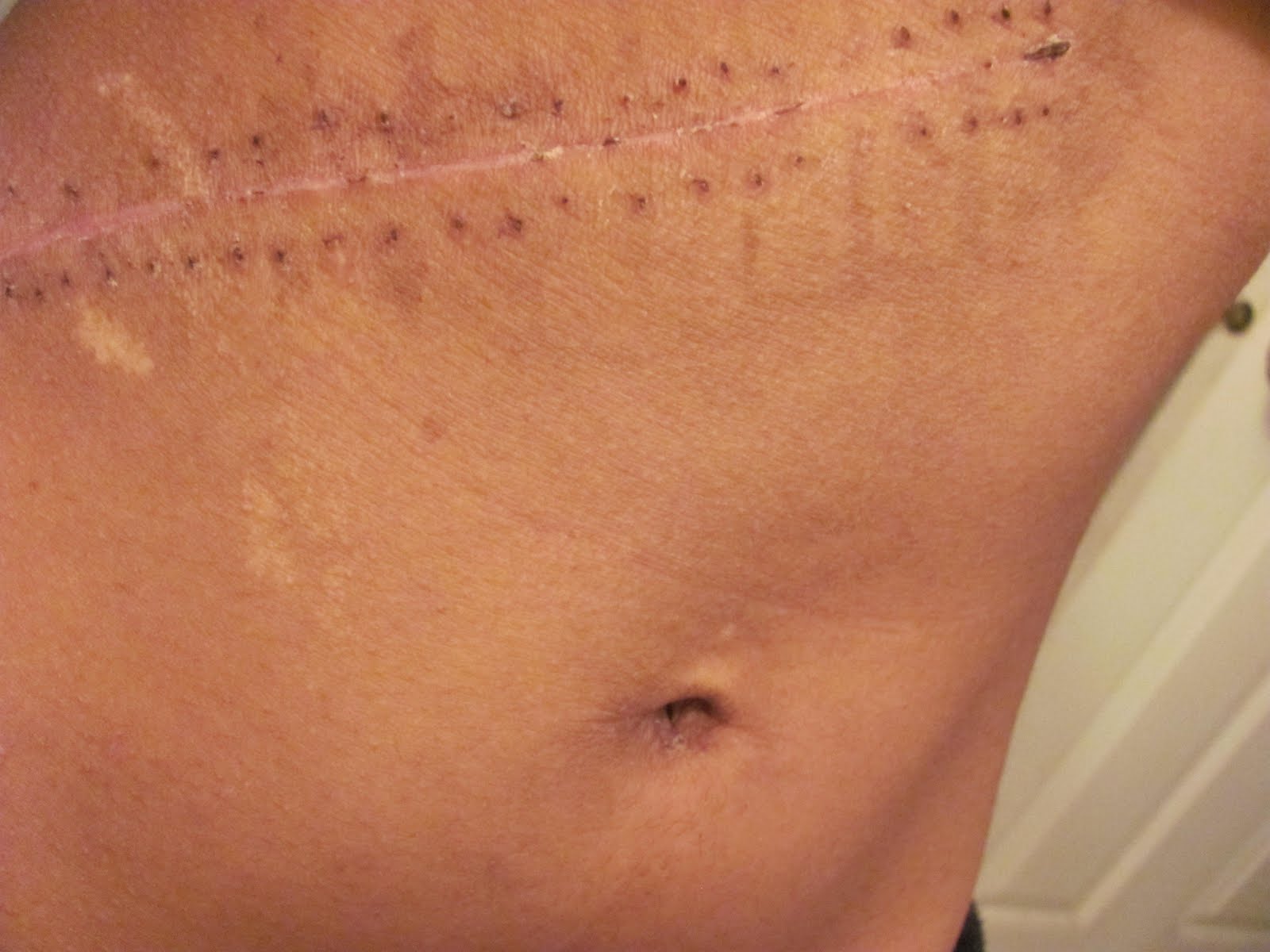 Stitches Scars