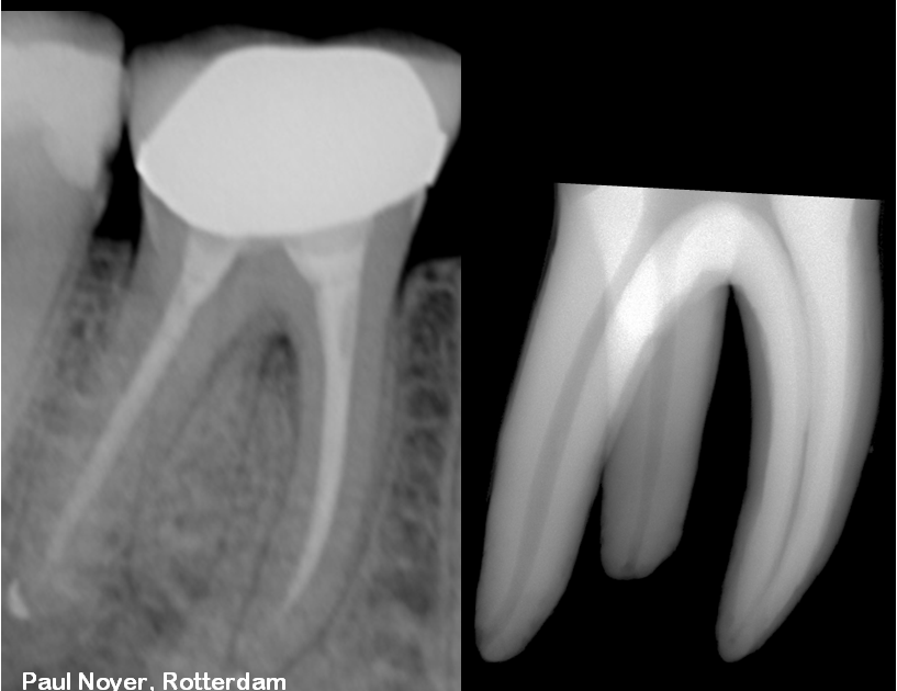 The Root Canal Anatomy Project Mandibular Second Molar Radix Entomolaris