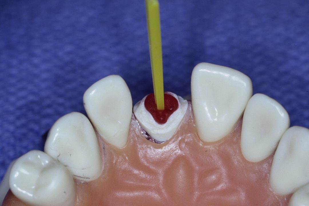 Dentistry Custom Cast Dowel Core