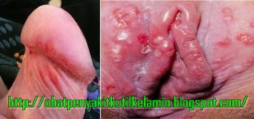 Penyakit Herpes Penyakit Herpes