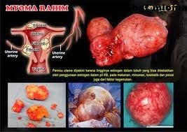 Cara yang aman mengobati miom tanpa operasi Cara yang aman mengobati miom tanpa operasi
