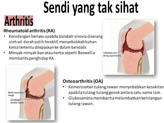 AJHT, advanced joint health tablet, sendi, Ostematrix, Omega Guard, sakit belakang, sakit lutut, sendi sihat, sendi tidak sihat,