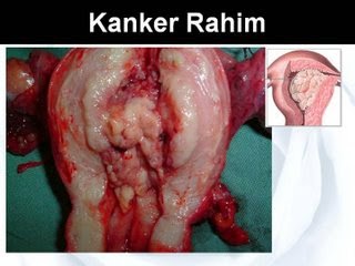 obat alami kanker Rahim stadium 2, obat kanker rahim, pengobatan kanker rahim