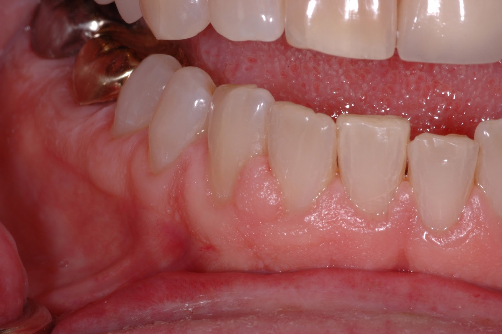 The Buzz from Your Favorite Dental Hygienists Gingival Enlargement