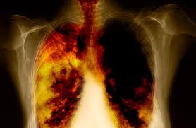Lung Cancer Picture