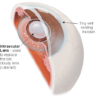 cataract disease