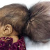 Bebé afgana con dos cabezas sobrevive a difícil operación