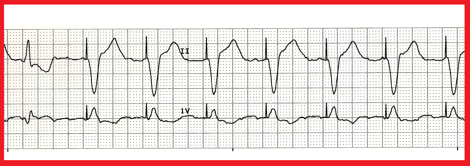 ventricular paced rhythm with failure to capture