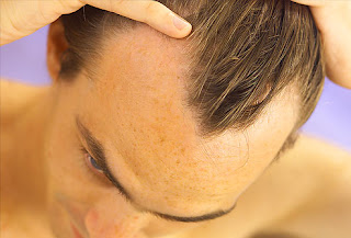 10 Pengobatan Alami Untuk Rambut Rontok Dan Kebotakan