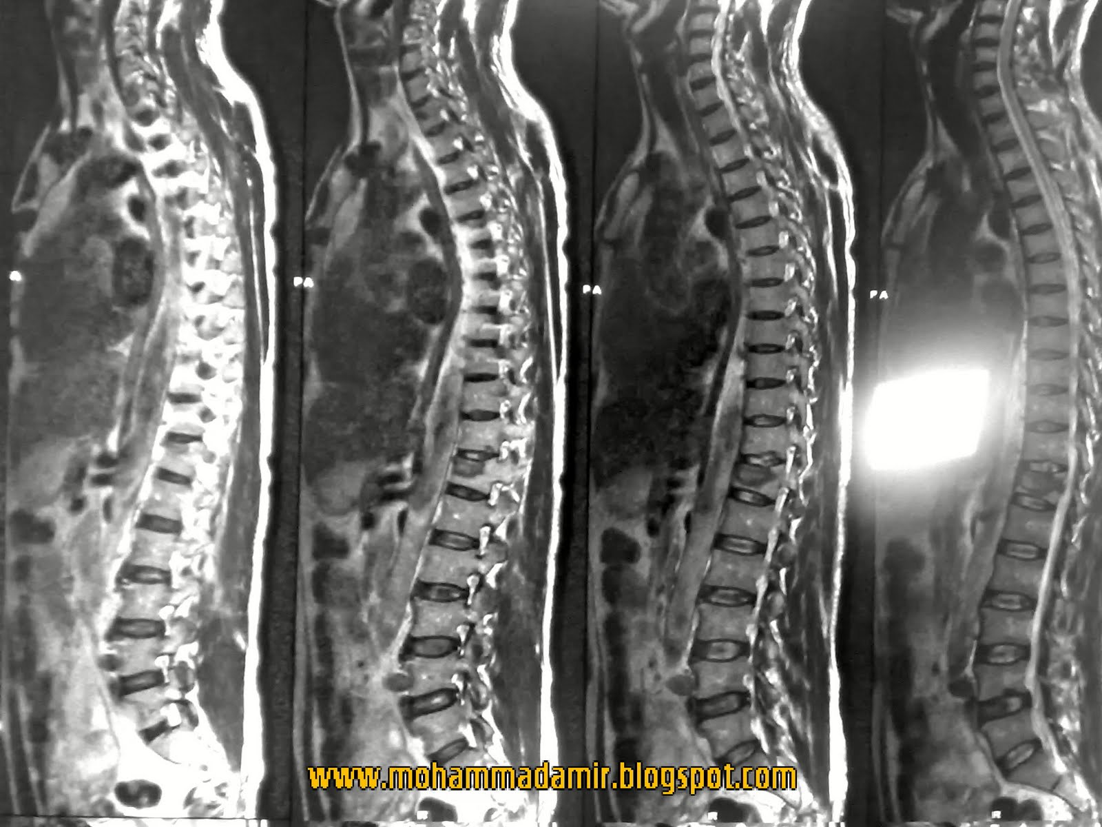 Fractured Vertebrae Compression Fracture of Lumbar Vertebrae-3.bp.blogspot.com
