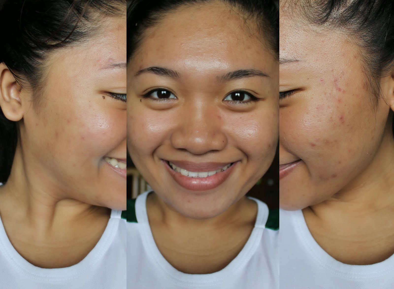 SKINMATE SHARK OIL REVIEW (How I Cleared My Acne)