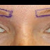 Implantes de cejas, la nueva tendencia femenina