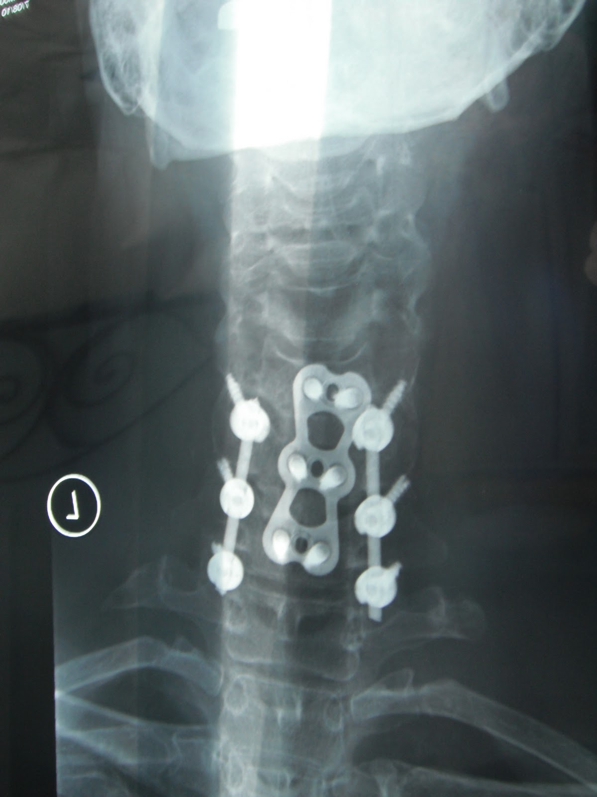 FINDING LANA 53 Broken Neck