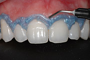 Clareamento dental . Av Edgard Romero, 224, sala 306, 3117-1721