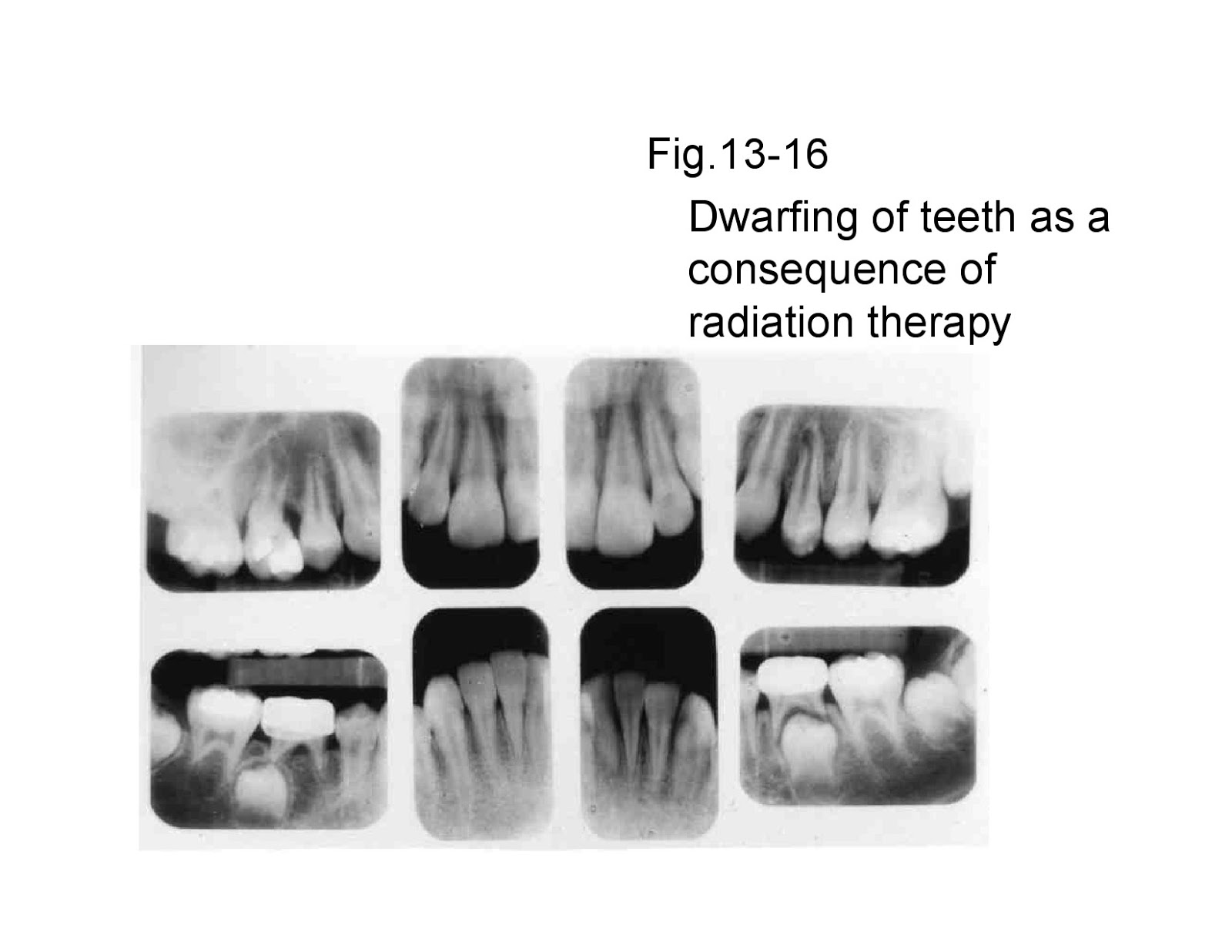 Osteomyelitiswith Radiological features Dentistry and Medicine