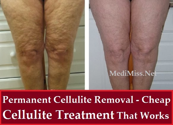 This Cellulite Works permanent cellulite removal cheap cellulite treatment This Cellulite Works permanent cellulite removal cheap cellulite treatment