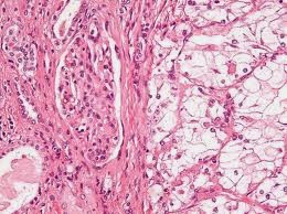 imagen Cancer Renal de Células claras