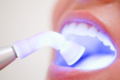 Tẩy trắng răng tại nhà