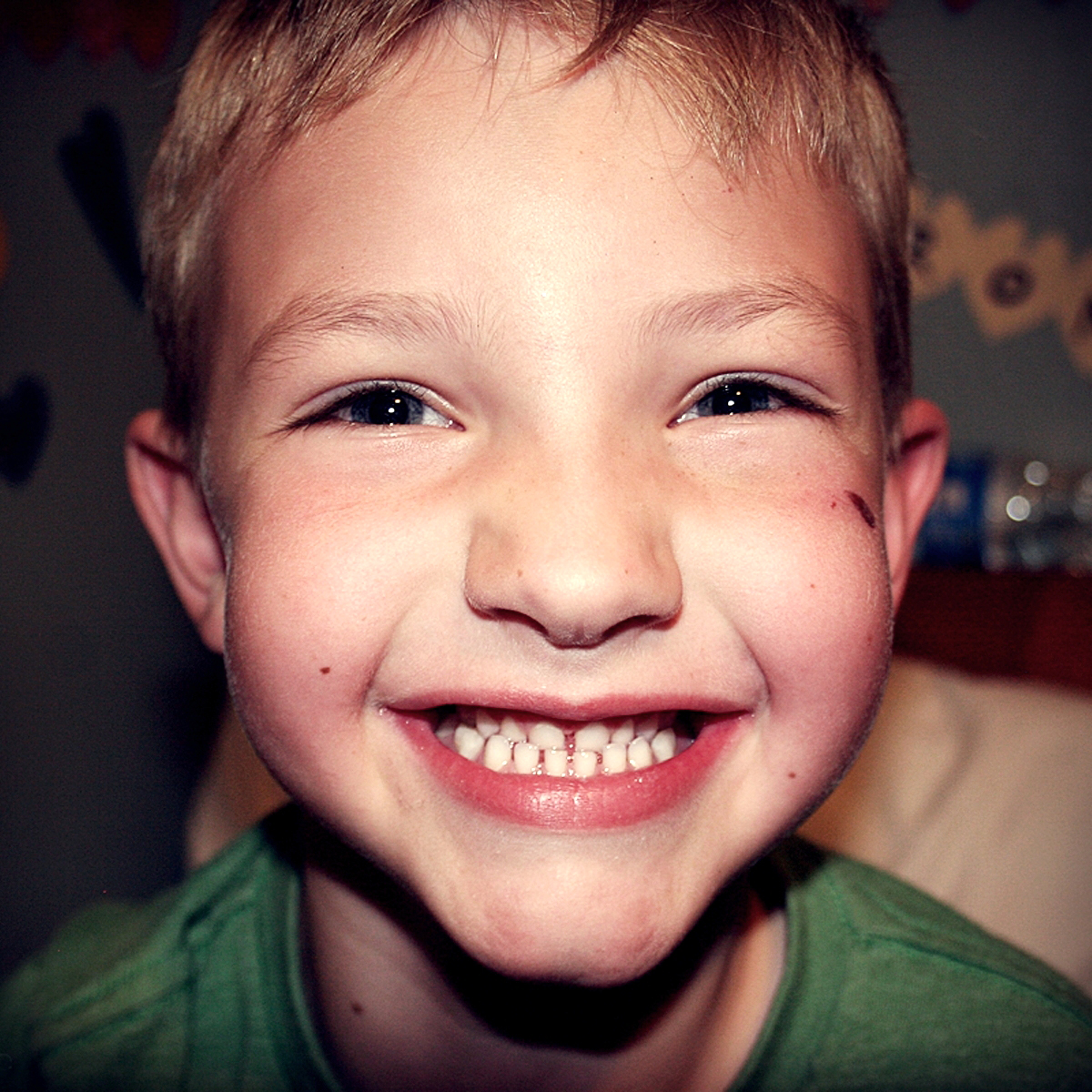 List 100+ Pictures Children's Rotten Teeth Photos Excellent