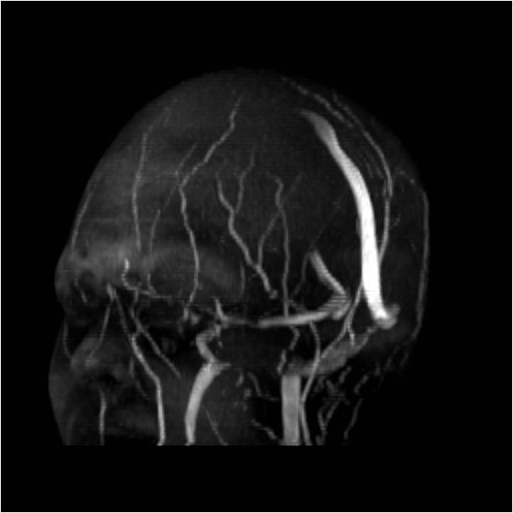 Neuroradiology On the Net Pseudotumor cerebri Idiopathic Intracranial Hypertension (IIH)