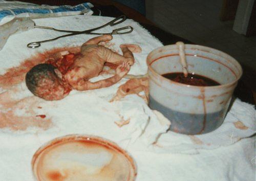 http://3.bp.blogspot.com/-ljtj--5Sbqk/TxWTM7WZtWI/AAAAAAAAAG8/vAnEeomECgg/s1600/partial20birth.jpg