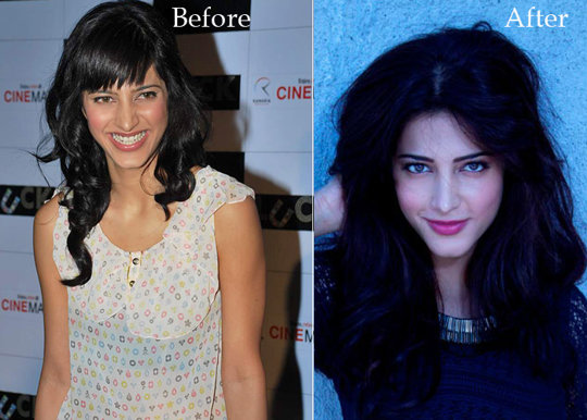 Brootle: Shruti Hassan Before and After Plastic Surgery