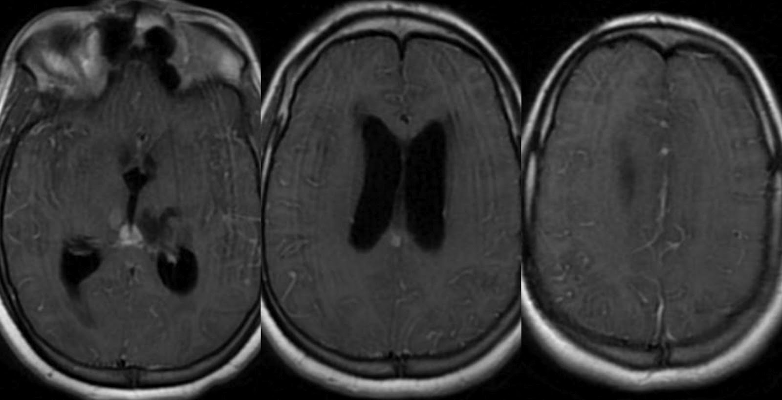Dr Balaji Anvekar FRCR Basal exudates in Tuberculous meningitis