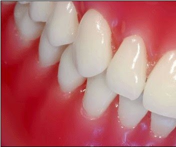 gencive Irritation autour de la dent
