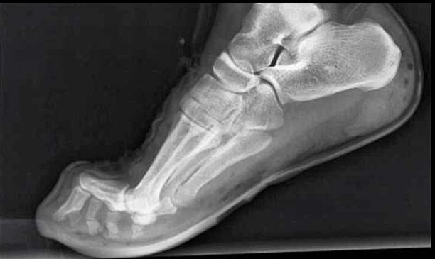 Tom�s Physiotherapy Blog Feet and rock climbing