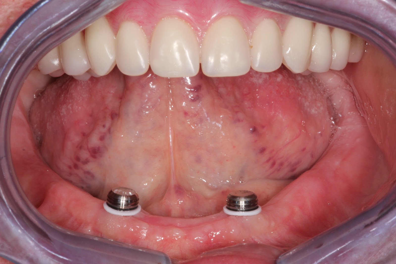 intaglio dental