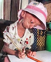 an overview of the causes of progeria its symptoms and treatment The main causes of progeria are abnormalities in the nucleotide structure of the dna of the nucleus is believed to cause the aging signs experienced by to slow their normal growth rates between 18 and 24 months of age one of our editors will review your suggestion and make changes if warranted. an overview of the causes of progeria its symptoms and treatment The main causes of progeria are abnormalities in the nucleotide structure of the dna of the nucleus is believed to cause the aging signs experienced by to slow their normal growth rates between 18 and 24 months of age one of our editors will review your suggestion and make changes if warranted.
