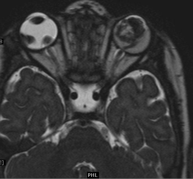 RetinoblastomaMRI Sumer's Radiology Blog