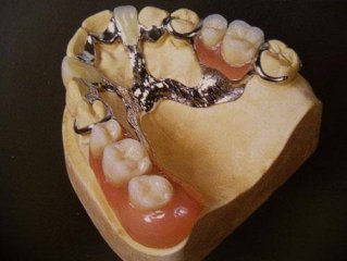Un bridge dentaire est la construction qui est fixee sur les dents adjacentes ou sur les implants. Ces protheses sont fixes. La longueur du bridge dentaire depend du nombre de dents a remplacer. On utilise plusieurs types de bridges dentaires differents par le mode de fixation:- Les bridges dentaires fixes sur les dents piliers. - Les bridges dentaires fixes sur implants. - Les protheses adhesives. - Les protheses dentaires adjointes,bridge dentaire, bridge dentaire prix, types de bridges dentaires, Ancrage dentaire collé, Ancrage dentaire scellé, Bridge dento-implanto-porté, Bridges dentoportés, forum bridge complet,bridge dentaire photo,bridge dentaire collé,implant dentaire,prix bridge dentaire collé,tarif bridge dentaire,colle dentaire en pharmacie,bridge 4 dents,dent de lait,dent bébé