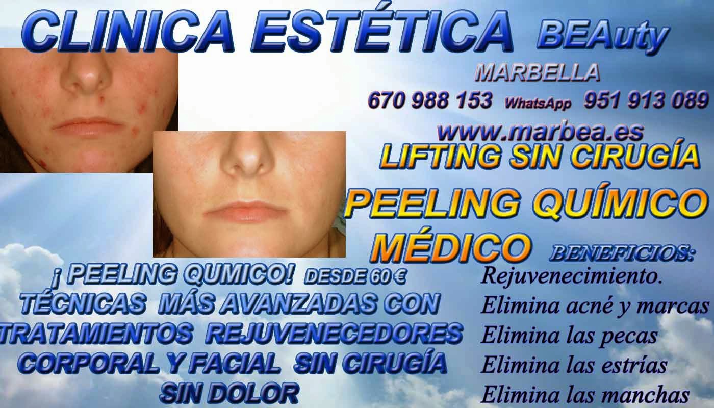 MARBELLA PEELING FACIAL QUIMICO MARBELLA PEELING FACIAL QUIMICO MEDICO PARA ELIMINACIÓN , QUITAR , TRATAMIENTO: ACNÉ , MARCAS , CICATRICES , MANCHAS ,PECAS , ESTRÍAS , MANCHAS