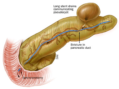 Informatii Medicale Despre Pancreatita Cronica Informatii Medicale Despre Pancreatita Cronica