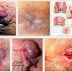 Obat Alami Buat Ambeyen Bengkak Berdarah thumbnail