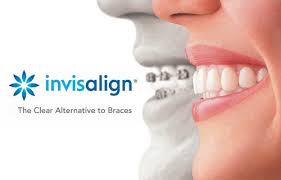 Invisalign Braces for Adults