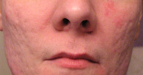 Treat Pimple Scars Blue Laser Acne Treatment