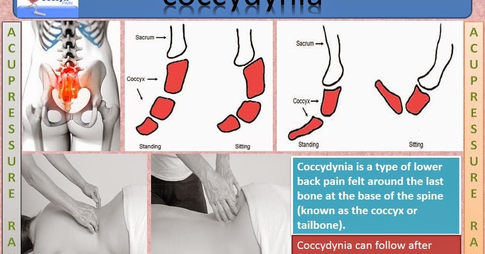Acupressure & Natural Therapy: Coccydynia