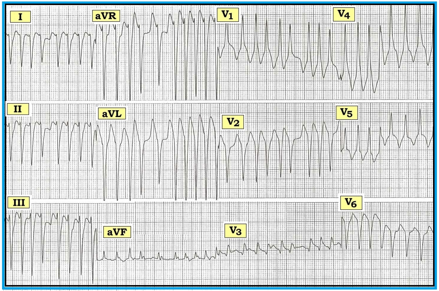 erratic ekg