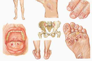 Симптомы хламидиоза