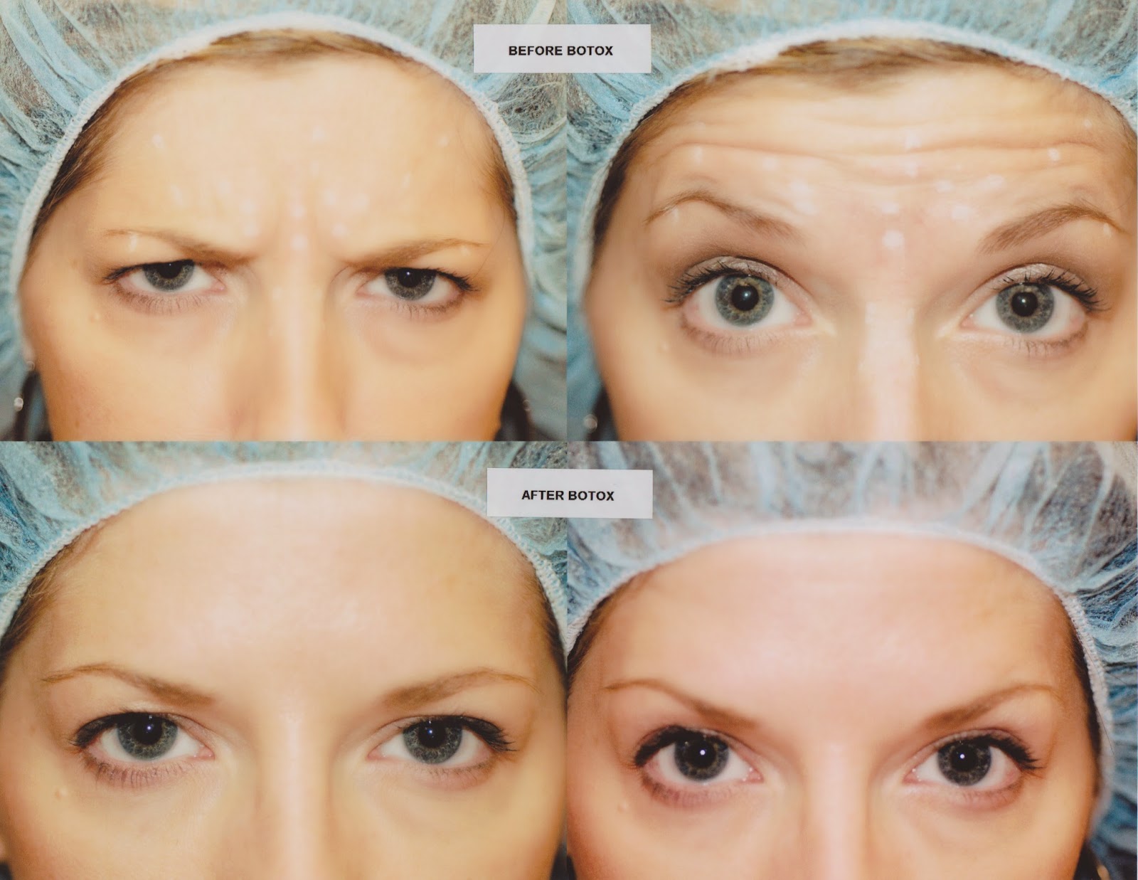 Qual O Valor Do Botox No Rosto FISIO E FORMA : BOTOX AMENIZA RUGAS E LINHAS DE EXPRESSÃO