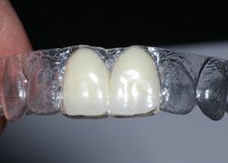 flipper teeth dental implant essix retainer temporary clear alternative tooth flippers smile cost missing false before snap dentistry cosmetic choices